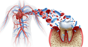 bleeding gums and diabetes